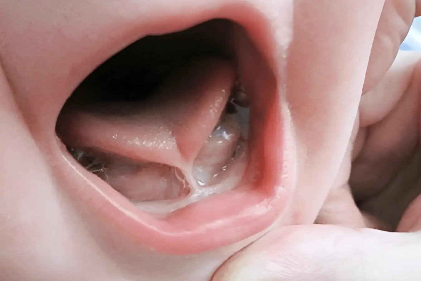 Types of Frenectomy