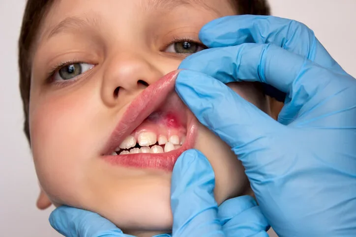 Dental Smart Kids dental lacerations treatment for child with injured upper gum being examined by pediatric dentist in Frisco TX