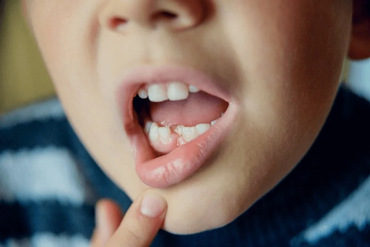 Dental Smart Kids dental laceration treatment in Frisco TX showing a child with upper lip injury being examined