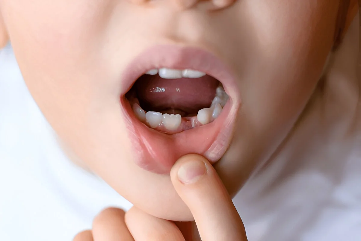 Dental laceration injury in child's mouth treated at Dental Smart Kids Frisco TX