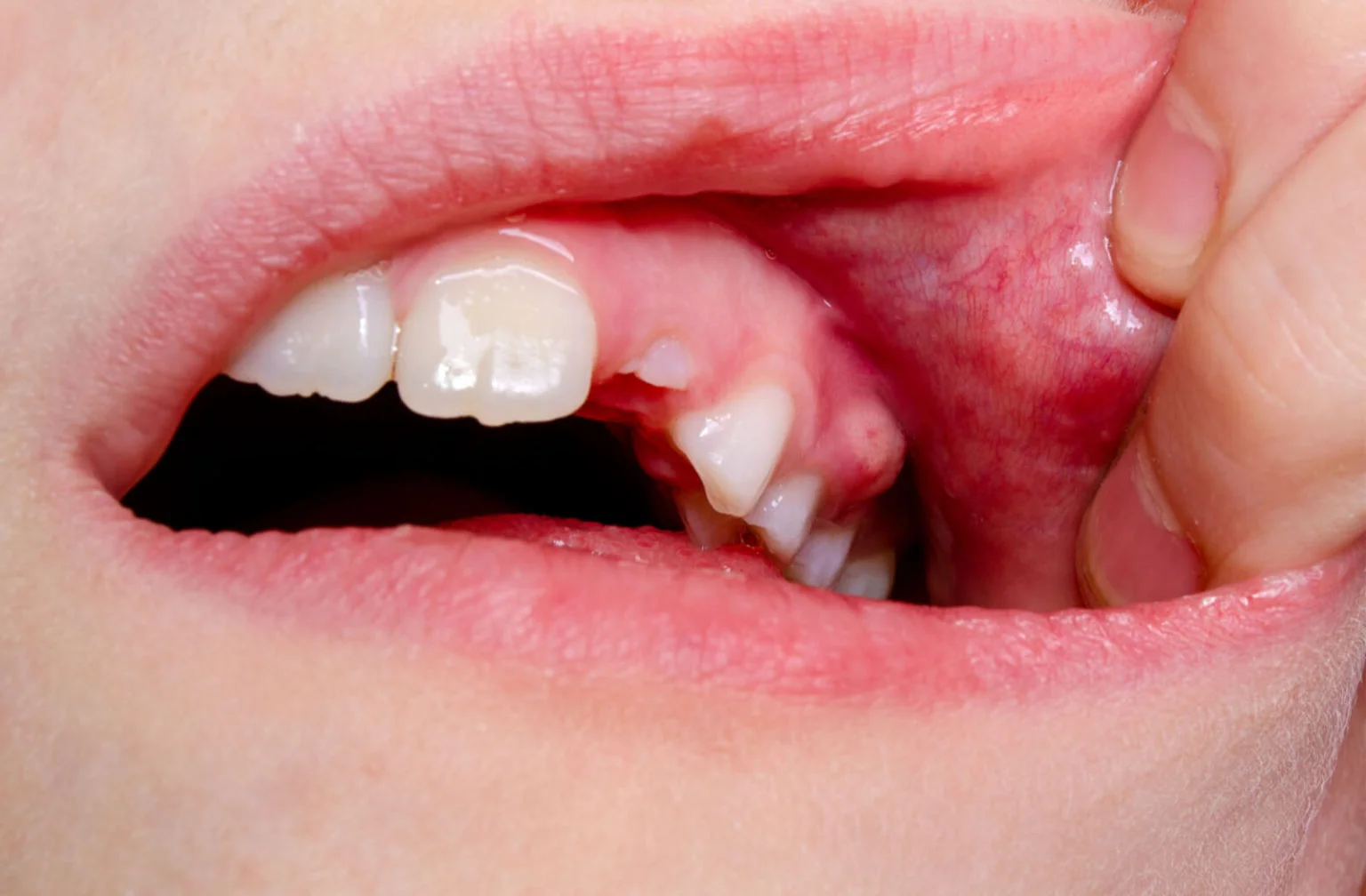 Dental swelling infection showing gum inflammation treated at Dental Smart Kids Frisco TX