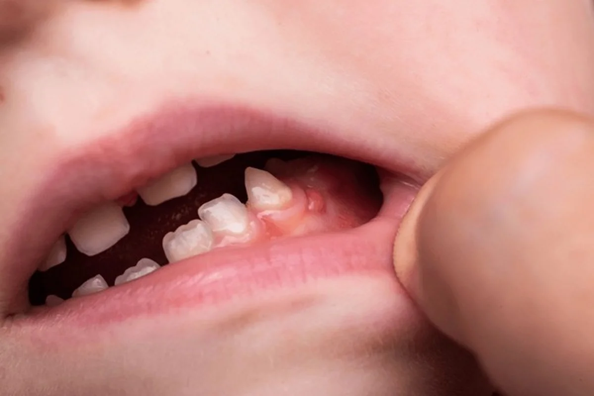 Dental swelling infection in child's gums treated by Dental Smart Kids Frisco TX