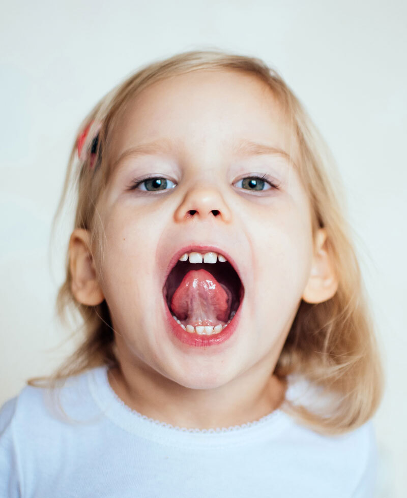 Lip tie surgery specialist Frisco TX at Dental Smart Kids: young girl showing upper lip tie before gentle laser release