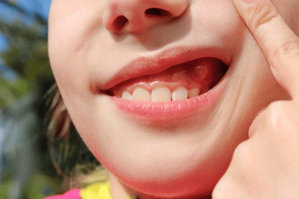 Gingival gum infection Frisco TX child showing red swollen gums at Dental Smart Kids