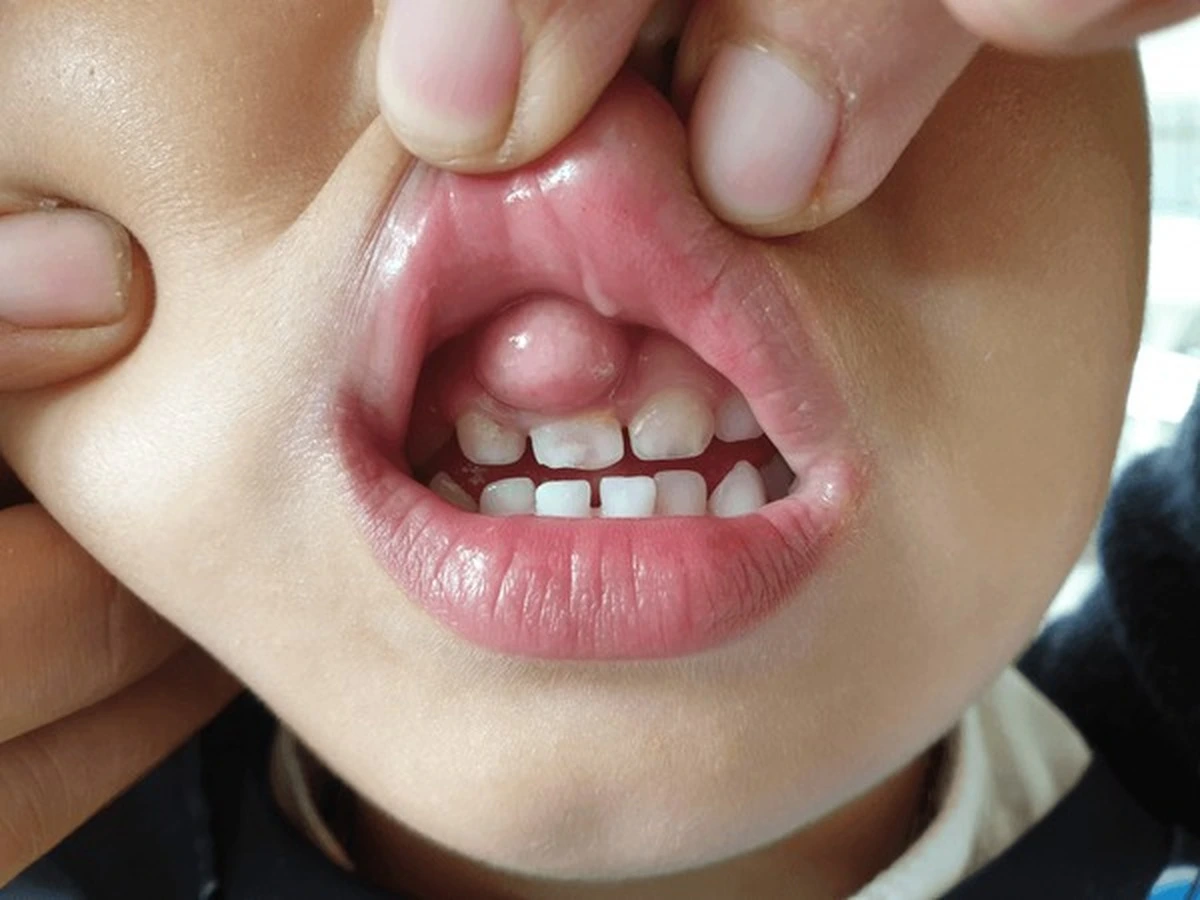 Gingival gum infection Frisco TX child with swollen gum abscess on upper lip at Dental Smart Kids