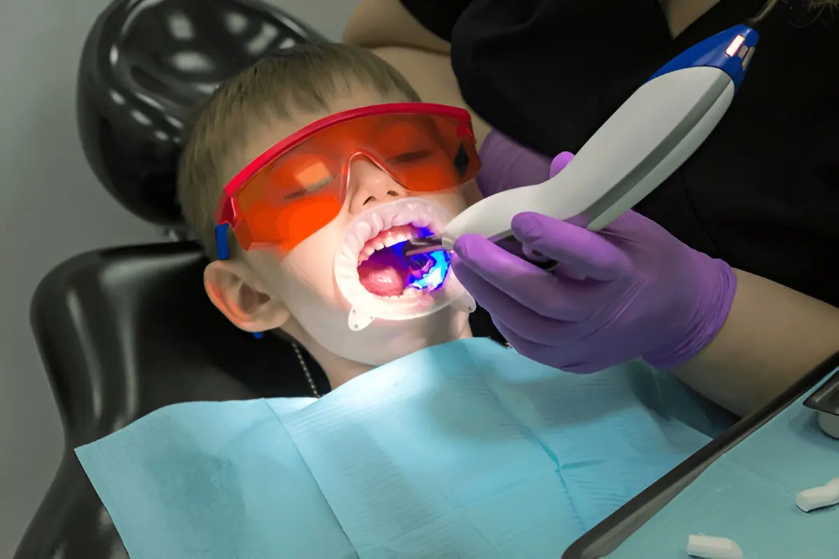Protective dental laser treatment for kids at Dental Smart Kids Dentistry in Frisco, TX, showing a child wearing safety glasses during a comfortable light-cured procedure.