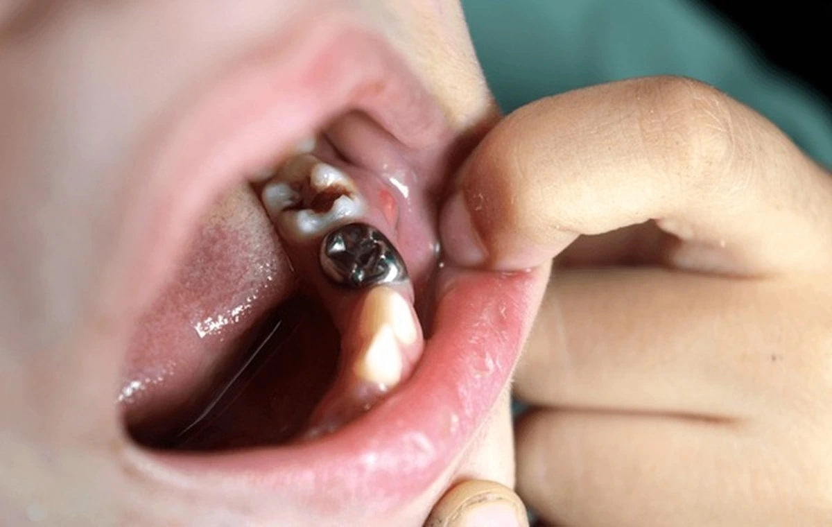 Pediatric space maintainer in action for kids in Frisco, TX – preventing tooth shifting after early loss at Dental Smart Kids