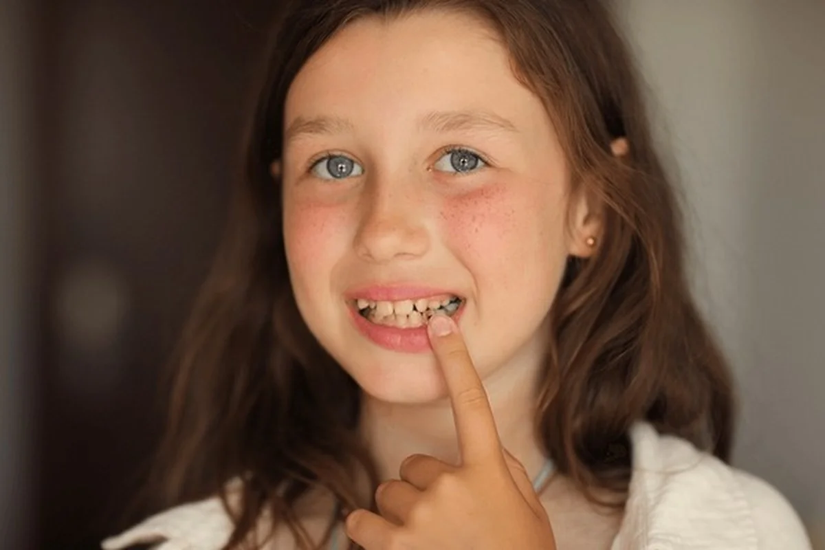 Tooth fractures Frisco TX: Girl pointing to chipped front tooth with reassuring smile at Dental Smart Kids